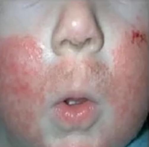 宝宝脸湿疹破皮出水反复,宝宝脸上溃烂流黄水怎么办