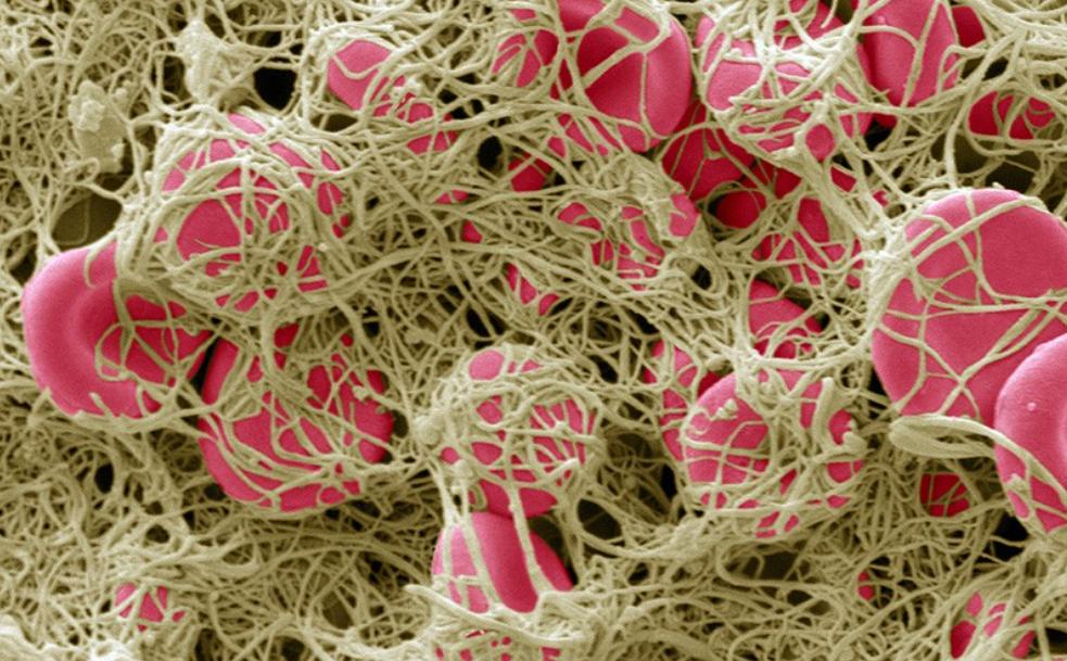 新冠中重症症状,重症新冠病人后遗症