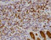 菁讲:你所不知道的横纹肌肉瘤