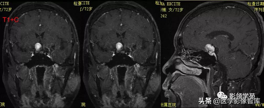 鞍区肿瘤做什么检查得出来,鞍区肿瘤的影像学鉴别