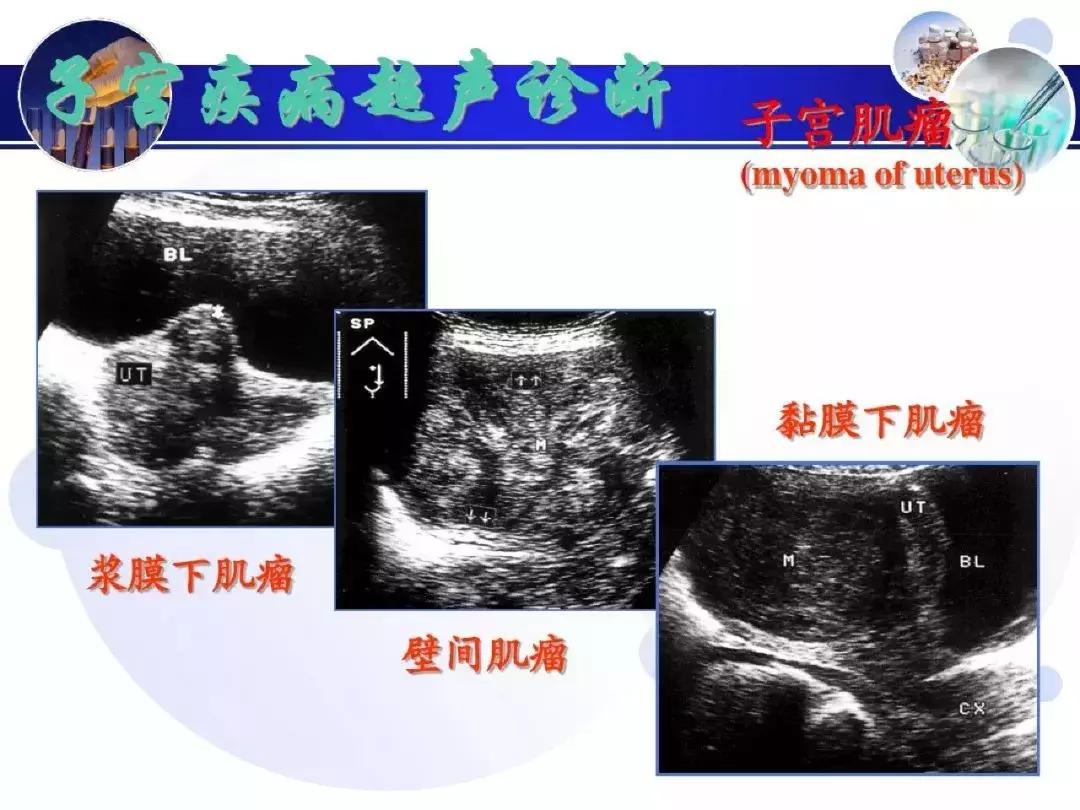 纯干货！子宫及附件解剖和超声诊断