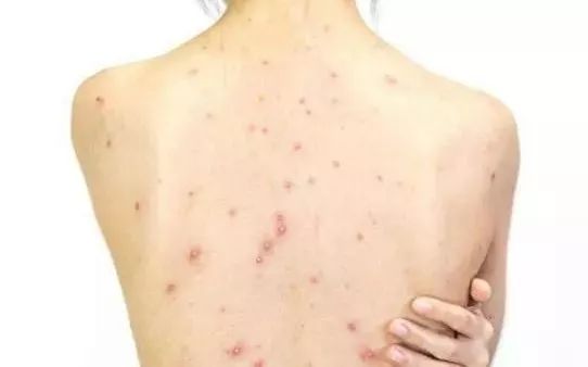 背上长痘痘有什么方法可以消除,背上长痘痘有什么简单的解决方法