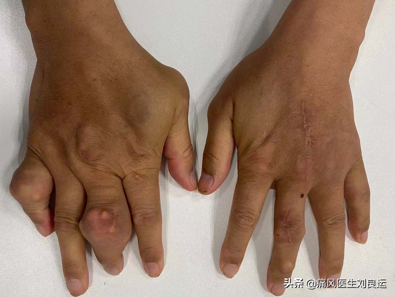 痛风发作大脚趾不能活动,痛风发作时只痛不肿不热为什么
