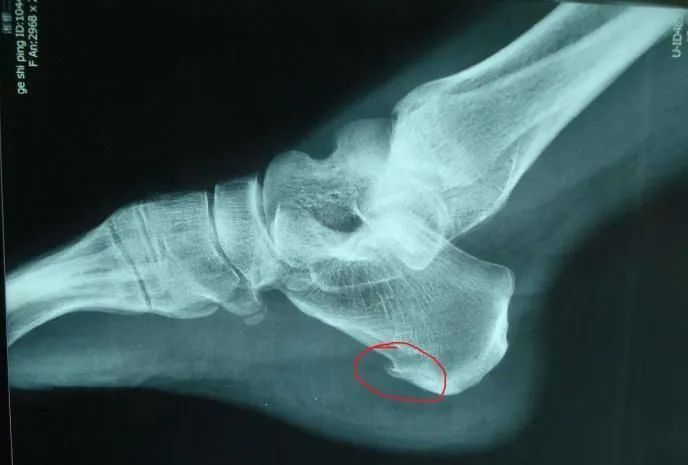 治疗足跟骨刺南阳,骨科康复医学科普骨刺