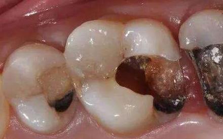 被牙痛折磨的痛苦你真的无法体会,牙医都不会告诉你的牙疼方法