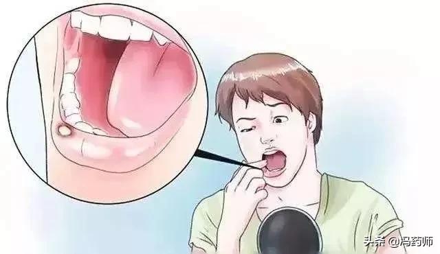 白色口腔溃疡特效药一览表,大面积口腔溃疡用什么药好得快