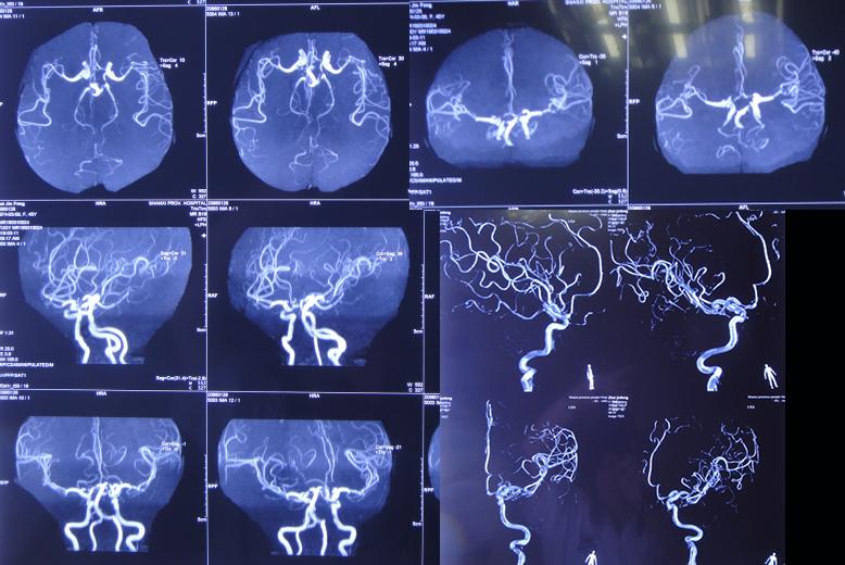 脑出血后脑积水会造成意识不清吗,脑出血后脑积水发高烧危险期多久