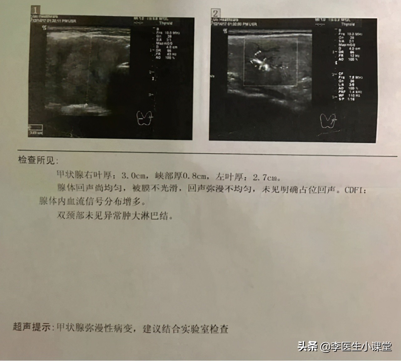 桥本氏甲状腺炎会引发ca125升高吗,桥本氏甲状腺炎能自愈或治愈吗