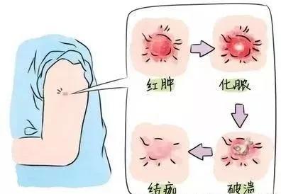 春游被蚊虫咬了怎么办,五一踏青小心毒虫叮咬