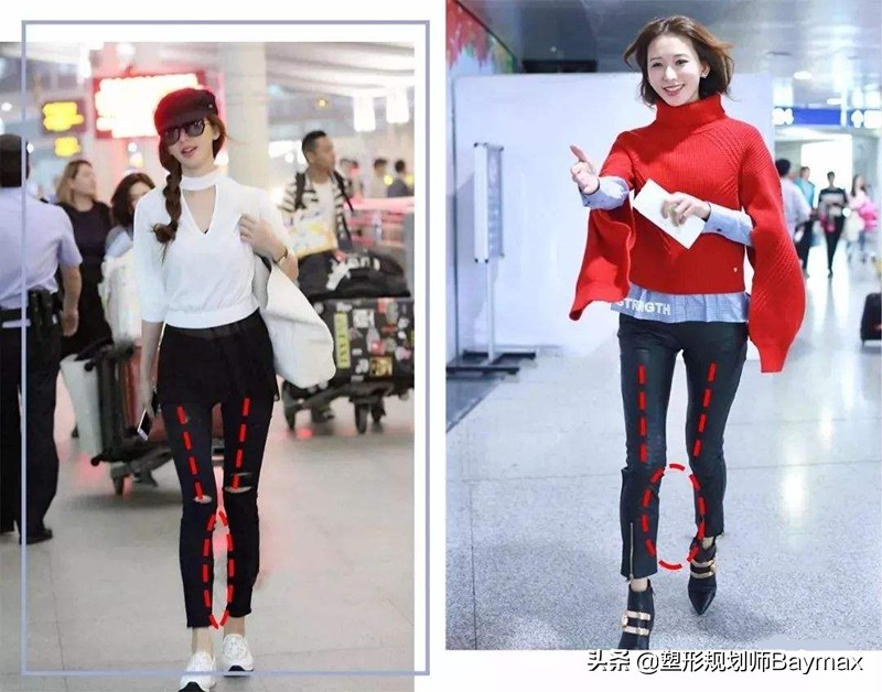 改善xo型腿最有效的训练方法,xo型腿和假性o型一样吗