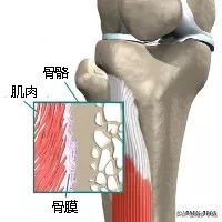 伤害了1/3跑者的胫骨炎,请务必重视起来