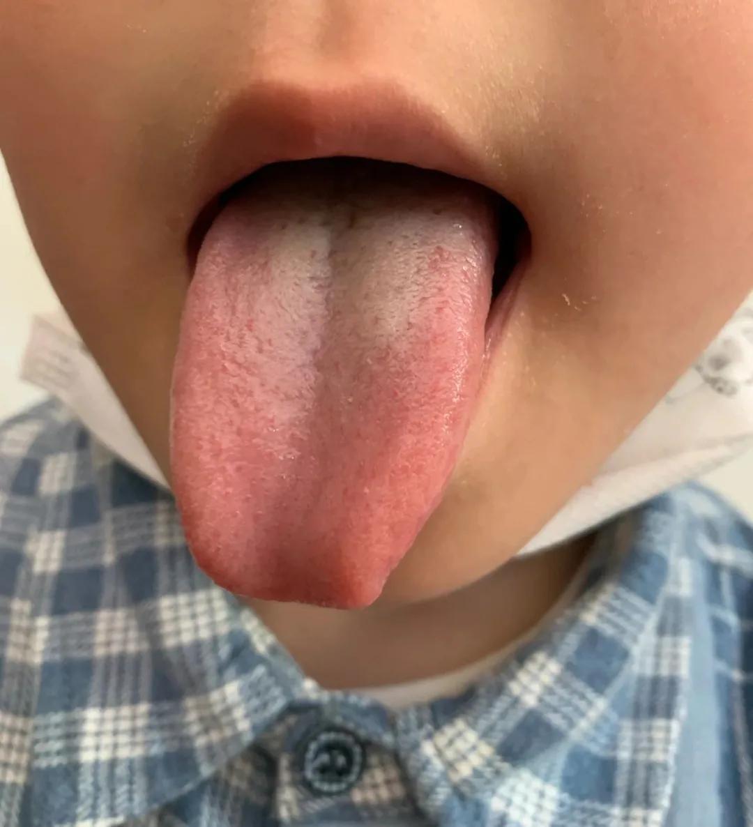 风寒感冒咳嗽最有效的推拿手法,风寒咳嗽推拿手法成人