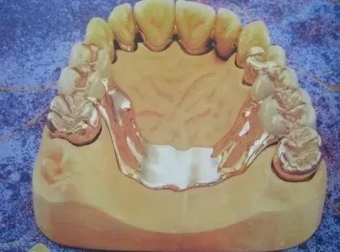 换一副烤瓷牙什么材料比较好,各类烤瓷牙材料的优缺点对比