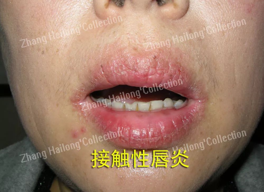 唇炎反复和口红有关系吗,都是红唇惹的祸