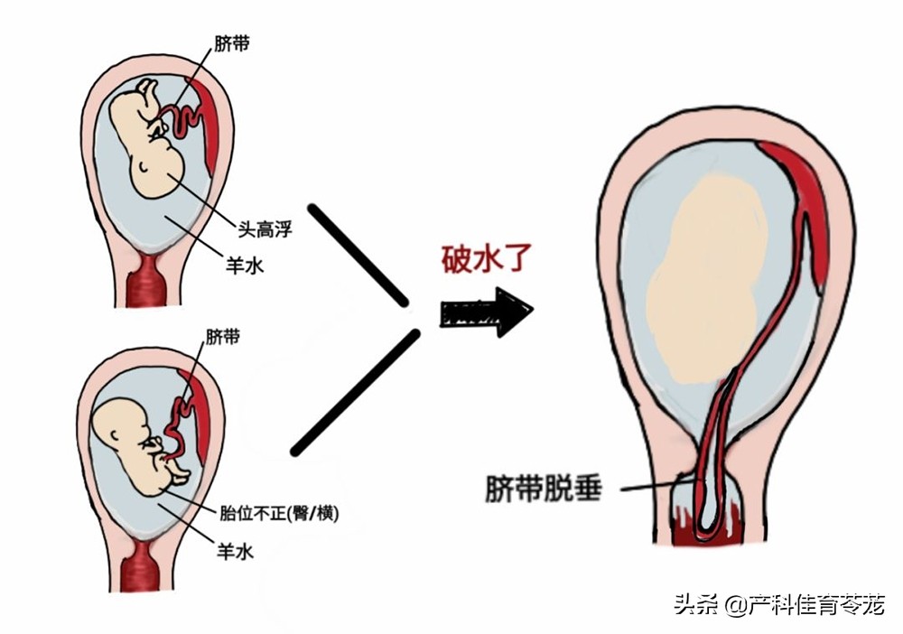 脐带脱垂,破水以后最害怕的事儿