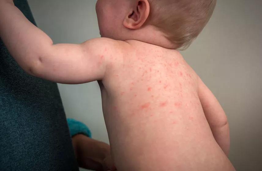 小孩脸冬天出冻疮还有红疙瘩,冬天皮肤湿疹干燥发痒怎么办