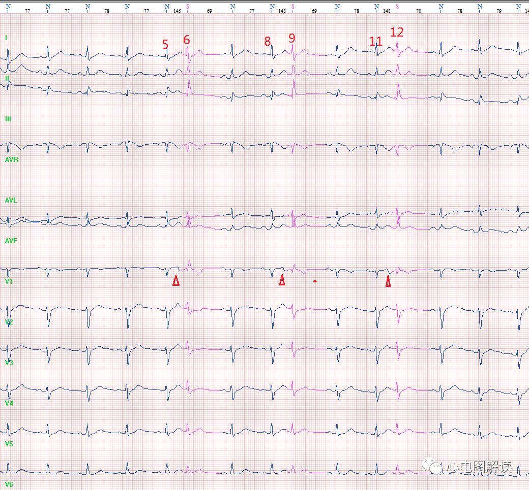 今天做心电图,每日分享心电图