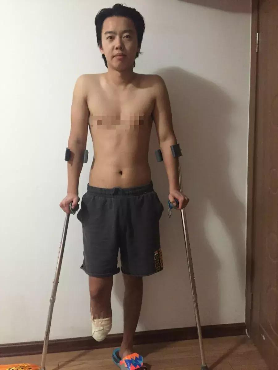 中国留学生被截肢,励志留学生