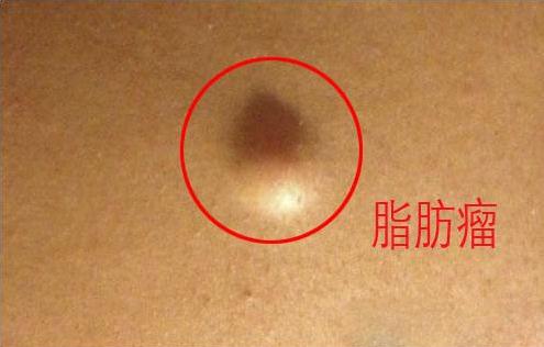 脂肪瘤是真的么,颅内长脂肪瘤伴有了癫痫怎么办