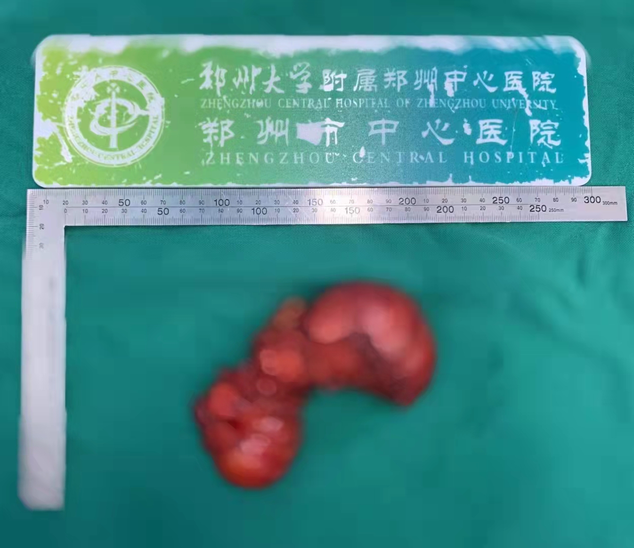 臀部长了一个瘤子是怎么回事,臀部上长个瘤子不疼不痒软软的