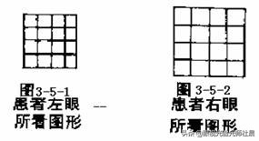 两只眼睛只有一只近视,一个眼睛近视了不戴眼镜会怎么样