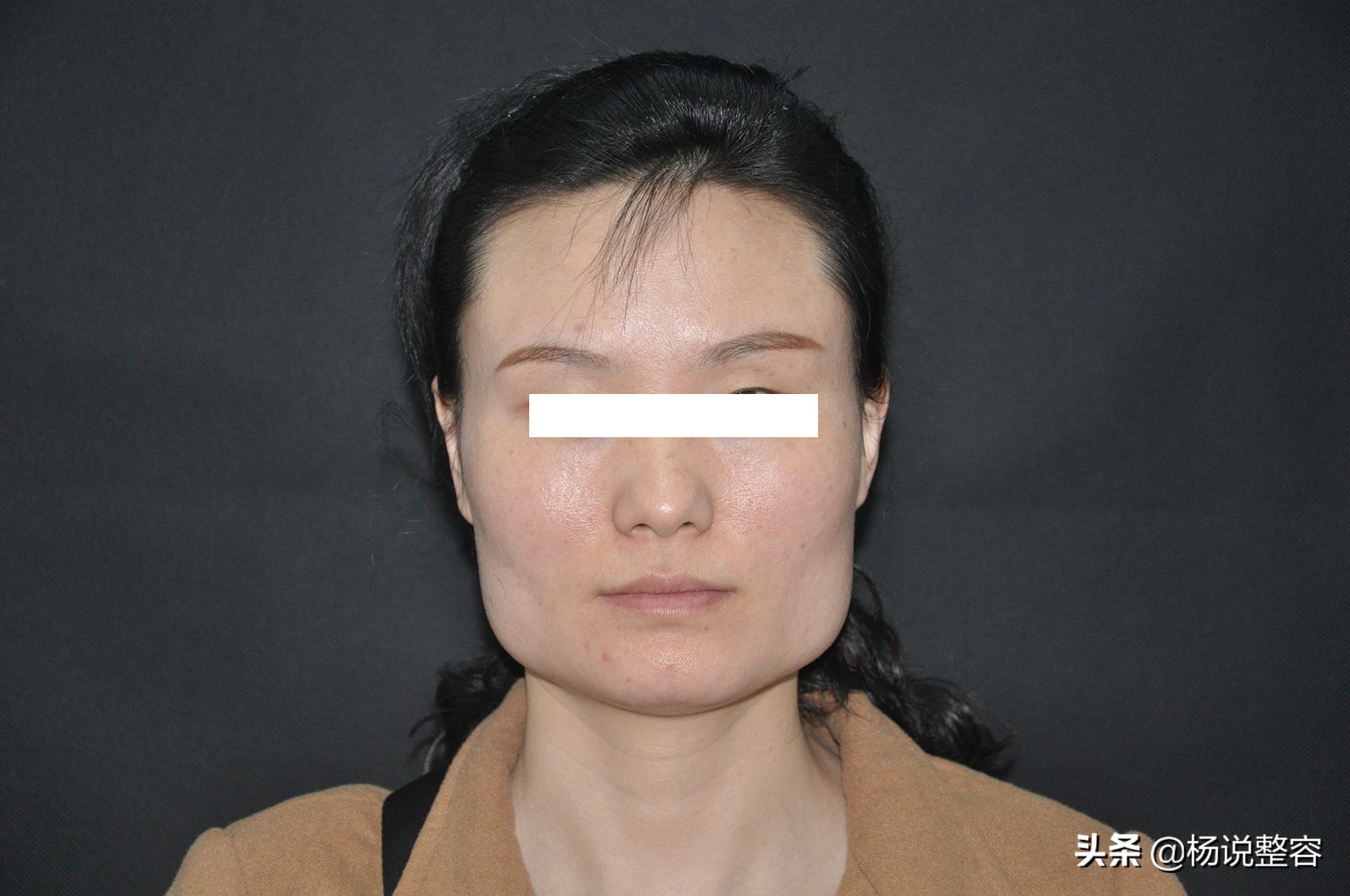 为什么会下颌突出,为什么下颌角突出