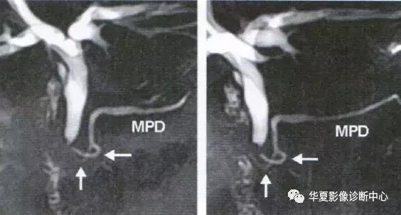 副胰管与主胰管图谱,主胰管型和分支胰管型如何鉴别