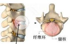 腰椎突出和膨出脱出图片,腰椎间盘突出脱出膨出的区别