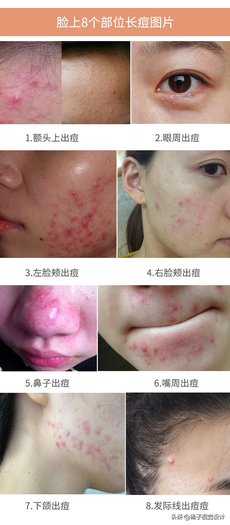 脸上长痘痘特别严重怎么快速消除,脸上长痘痘怎么办快速解决图片