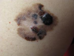 去掉身上的痣挂什么科,身上的色素痣去除的最好方法