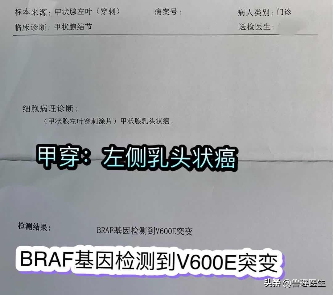 甲状腺滤泡癌病例分析,左侧颈部甲状腺癌有什么症状