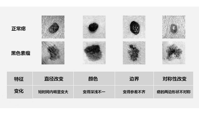 色素痣如何判断病变,色素痣怎么看出有癌变可能