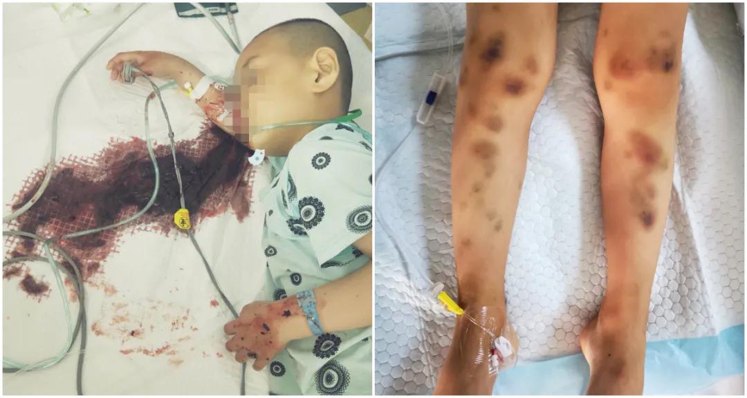 血液净化技术在急性中毒中的应用,血液净化机器治疗血液中毒