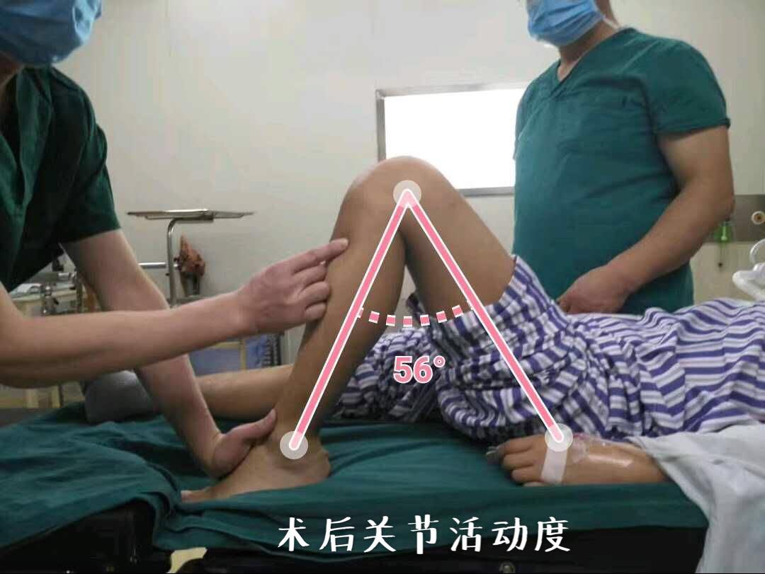 膝盖做了手术如何康复训练按摩,膝盖术后弯曲不了做按摩有用吗