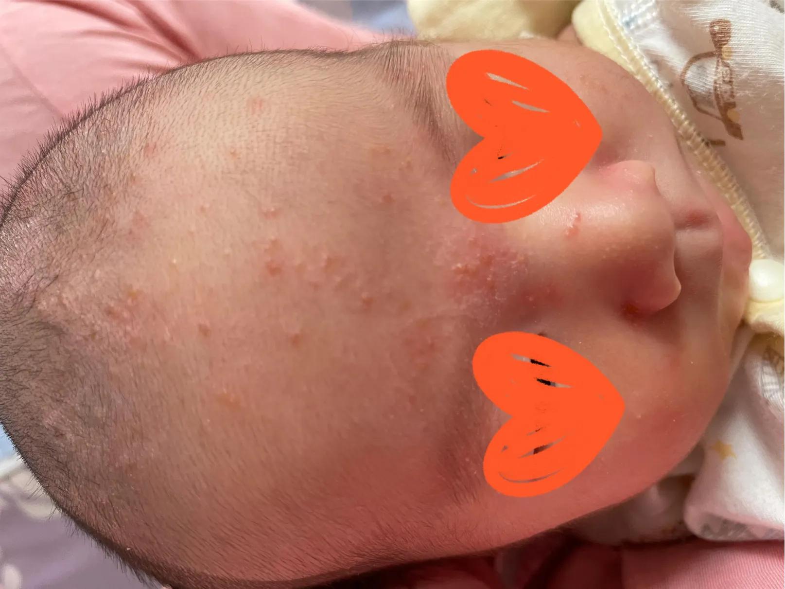 养宠物会不会造成孩子湿疹,宝宝湿疹跟家里养宠物有关系吗