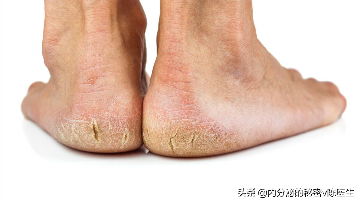 糖尿病出汗异常怎么办,中医糖尿病乏力出汗治疗