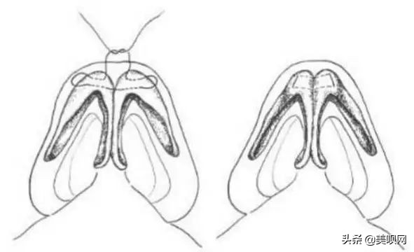 明星都在用的缩小鼻翼神器,明星鼻子做鼻翼缩小外切