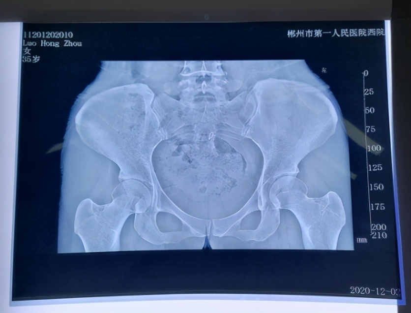 腰骶疼痛最佳治疗方法,腰坐骨神经疼了好多年怎么办