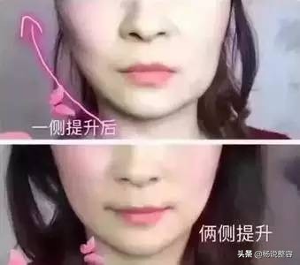 500元的微针和5000元的微针,线雕的优点和缺点