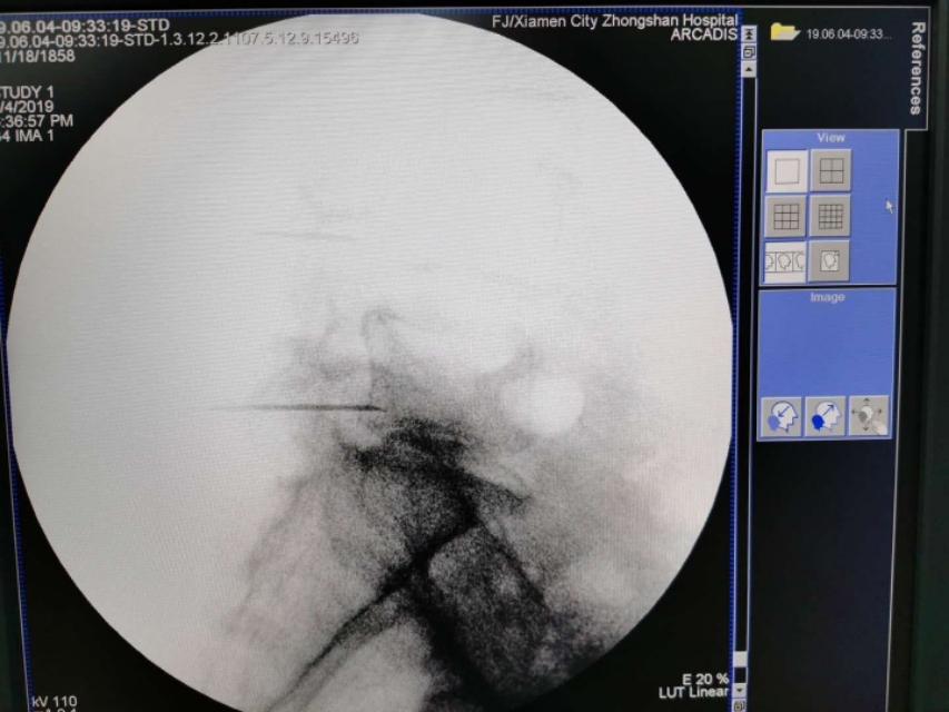 腰痛扎小针刀行吗,腰痛针灸需要吃药嘛
