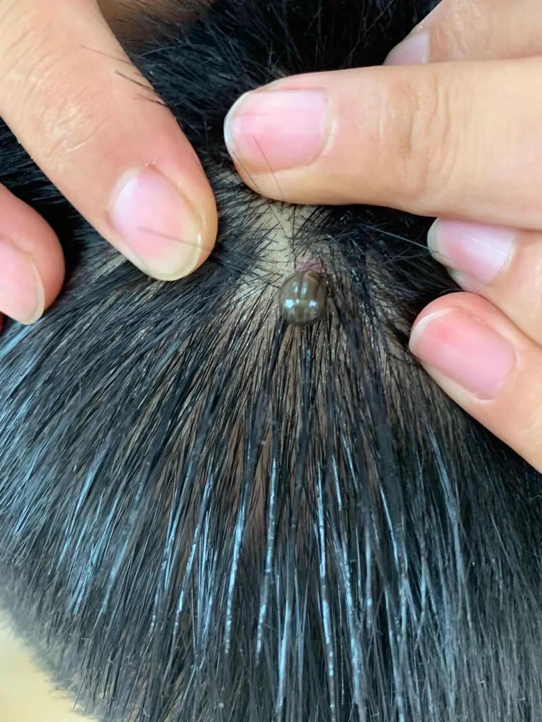 蜱虱咬伤怎么处理,蜱咬了怎么办