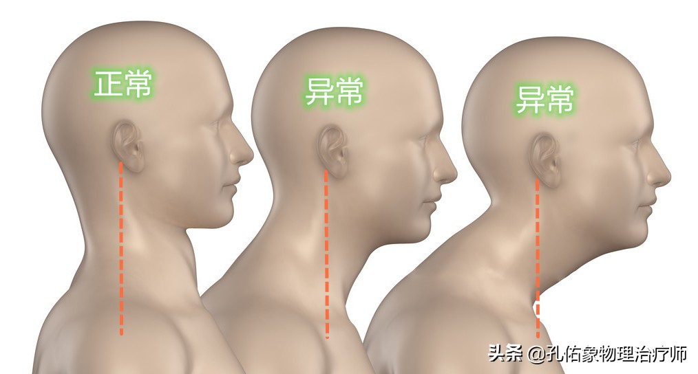 肩颈颈椎痛怎么缓解最快最有效,颈椎病最怕的5个症状