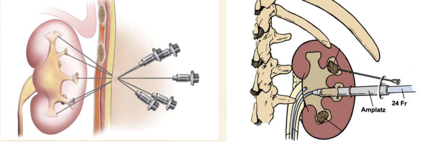 请问医生结石为什么老是排不完,为什么医生拿小的结石没有办法