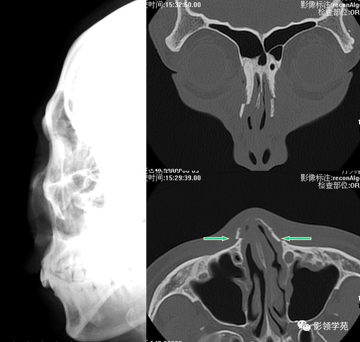 鼻骨骨折的检查方法,鼻骨骨折影像学表现