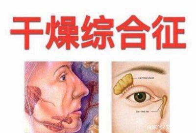 得了干燥综合症怎样用药,干燥综合征注意事项