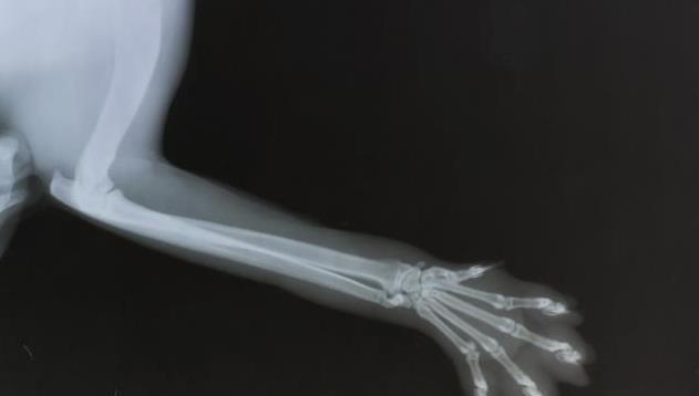 肥大性肌营养不良的症状表现,肥大性肌营养不良怎么办