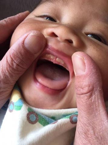 孩子口腔溃疡老是不好怎么办,孩子口腔溃疡老不好是怎么回事