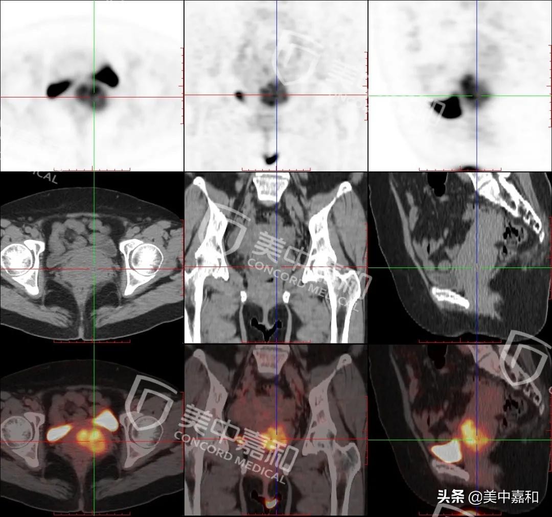 大姨妈突然提前是更年期吗,大姨妈一直来是不是宫颈癌