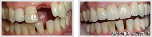 郴州种植牙医院哪家好,郴州牙科哪家医院好