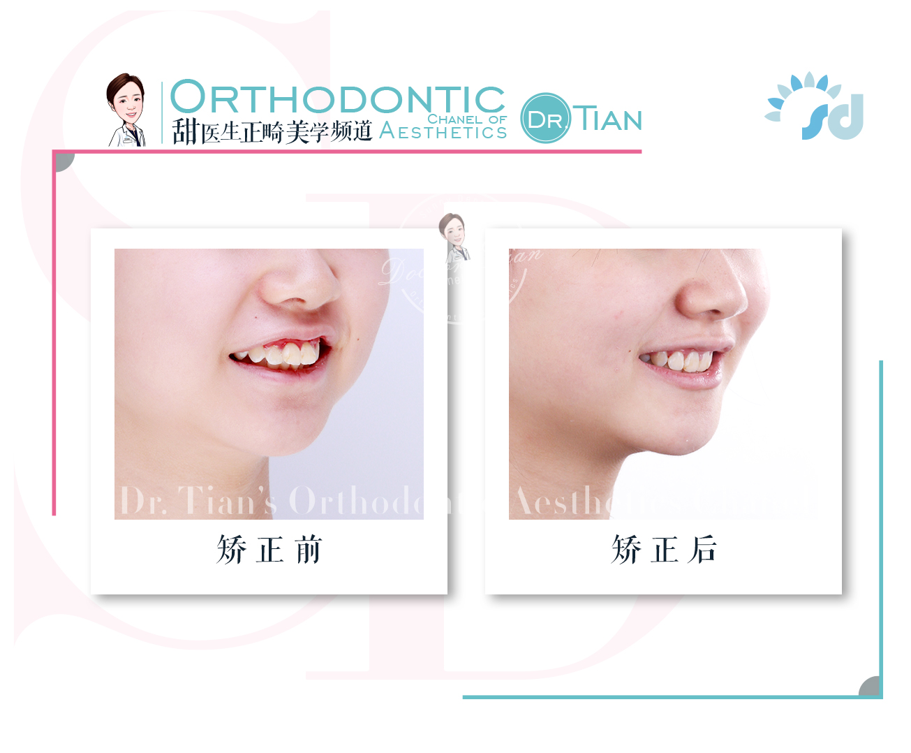 成年人第二磨牙锁合还能矫正吗,西安哪家医院牙齿深覆合矫正好